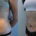 Липокаскция помогла избавиться от спасательного круга на талии